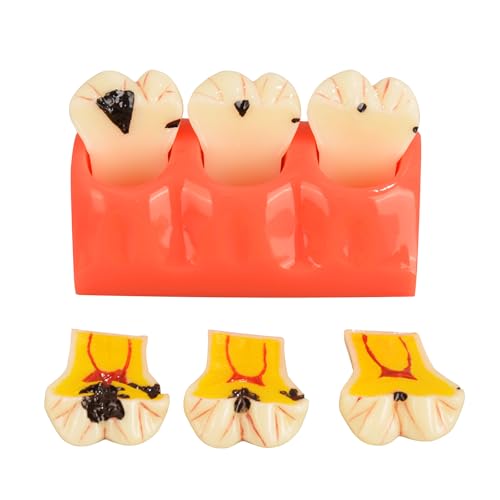 Ultrassist Dental Caries Teeth Model 4 Times Dental Tooth Decay Model Caries Bilateral Comparison Pathology Model Teeth for Dental Education Supplies, Tooth Pathology Display