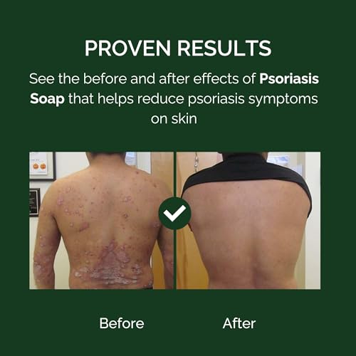 Image of KENGOLD P soriasis Skin and Hair Soap | 75g Herbal Bathing Bar with Natural Ingredients | Gentle Daily Cleansing for Skin Hydration, Scalp Care, Refreshing Lather & Natural Protection | Suitable for Men & Women (Pack of 1)