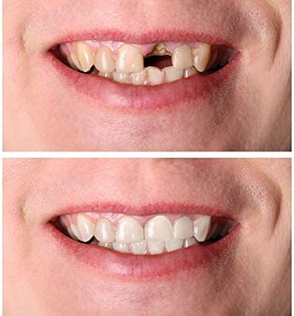 4 Pairs Cosmetic Veneers Teeth Temporary Dentures Teeth Instant Teeth Top And Bottom Veneers Snap On Comfort Dentures For Bad Teeth Amazon Co Uk Health Personal Care
