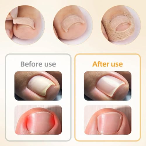 Image of 101 /190pcs Ingrown Toe Nail Remover, Toenail Corrector Strips and Ingrown Toenail Correction Tool, for Daily Nail Care and Post-Exercise Maintenance (190PCS Brown)