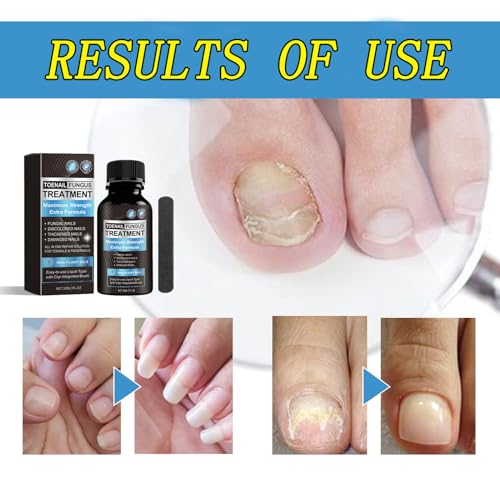 image for FORLUCIX Toenail Fungus Treatment,Toenail Fungus Treatment Extra Stren