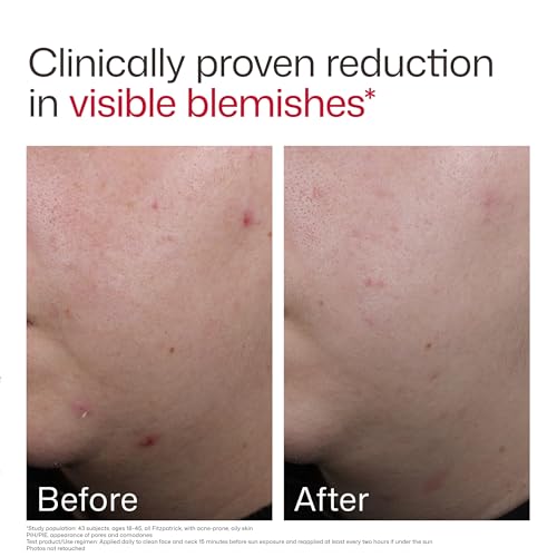 Image of EltaMD UV Clear Face Sunscreen SPF, Oil-Free Sunscreen with Zinc Oxide, Dermatologist Recommended