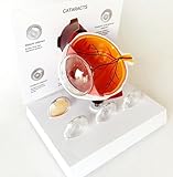 Cataract Eye Model, Eye Anatomy Cataract Eye Physician Research Model, Human Body Anatomy Eye w/Cataract Conditions for Doctors Office Educational Tool