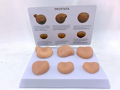 Teaching Model Tools,Prostate Lesion Model Six Full Size Contrast Normal Prostate and Prostate Cancer Model Anatomical Prostate Model for Study Display Teaching