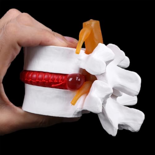 Modèle de hernie discale lombaire pour simplifier les cours d'anatomie complexes
