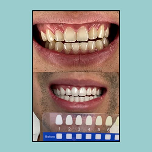 Sol Teeth Whitening Kit With Led Light, All Natural Vegan Teeth Whitening Gel Made For Sensitive Teeth, 3 Professional Grade Whitening Pens, Remineralizing Pen, Led Mouthpiece, Shade Guide & Case #TOP3