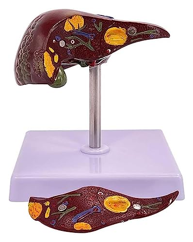 Modèle anatomique du foie détachable pour expliquer les pathologies - 2