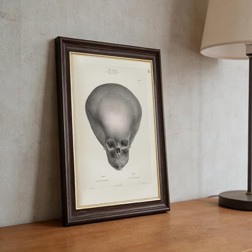Toile crâne d'hydrocéphalie Joseph Vimont cadre suspendre 20x30cm - 5