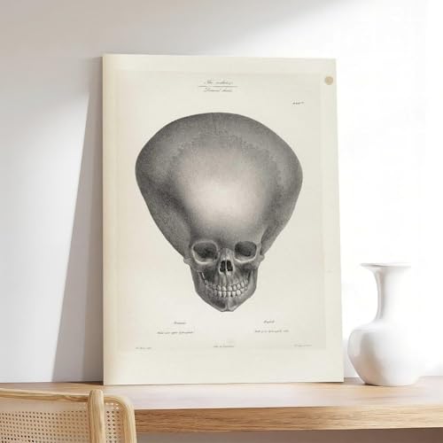 Impression sur toile crâne d'hydrocéphalie Joseph Vimont 50x75 cm - 7