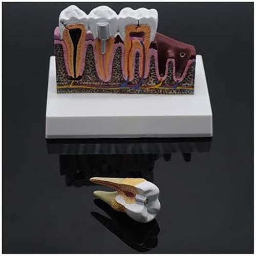 Modèle de démonstration de dents buccales avec structures amovibles de précision - 5