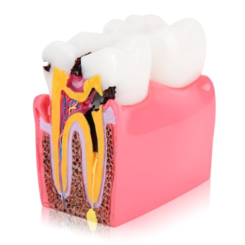 Agatige - Agatige Zahnanatomie-Modell, Karies-Vergleich Studienmodelle Zahnarzt Zahnanatomie-Ausbildung Zahnmodell Zahnkaries-Entwicklungsmodell