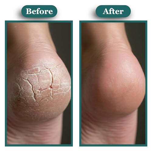 JANE VINE Kissable Feet, Athletes Foot Cream – Cream for Itchy, Dry Skin – Tea Tree, Coconut & Chamomile – Crafted for the Whole Family, No Sting – 3.5 oz
