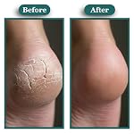 Kissable Feet, Athletes Foot Cream – Cream for Itchy, Dry Skin – Tea Tree, Coconut & Chamomile – Crafted for the Whole Family, No Sting – 3.5 oz - Image 2
