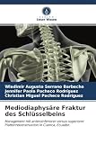 Mediodiaphysäre Fraktur des Schlüsselbeins: Management mit anteroinferiorer versus superiorer Plattenrekonstruktion in Cuenca, Ecuador. (German Edition)