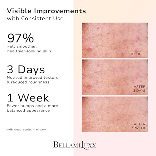 Image of BellamiLuxx Butt Acne Treatment Set: Acne Soap Bar + Butt Treatment Lotion for Breakouts on Buttocks, Thighs, Back, Chest & Ingrown-Prone & Folliculitis-Prone Skin - Helps Reduce Body Breakouts