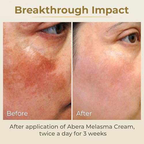 ABERA Melasma Cream (Premium Version) - Dark Spot Corrector, Melasma, Freckle, Sun Spot, Age Spot Remover Advanced Formula for Women and Men (0.7 Oz Per Item)