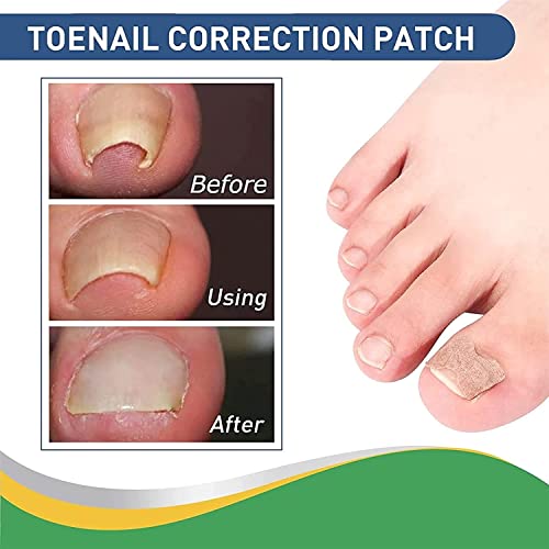 Treatment Ingrown Toenail Corrector Strips,Fitmedify Nail Patches with Nail Correction Tool Kit,Toenail Correction Patch,Ingrown Toenail Removal Kit - Image 6