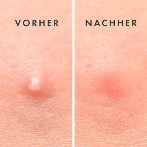 Rael Miracle Anti Pickel Patch Unsichtbar (2 Größen, 96 Stück) – Ansicht 6