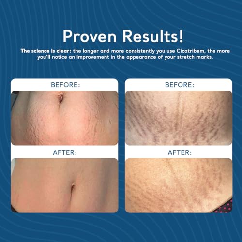 Creme para Estrias Cicatribem 150g - Creme Corporal Previne Estrias e Hidrata com 96% de Eficácia