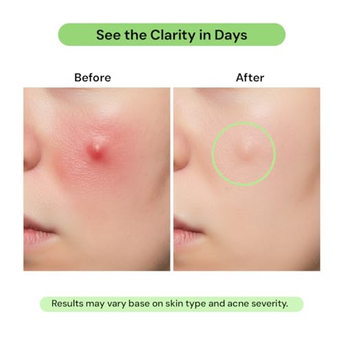Image of Acne Dot Gel Enriched with Acne Buster, Salicylic acid (1%), Azelic Acid & Niacinamide
