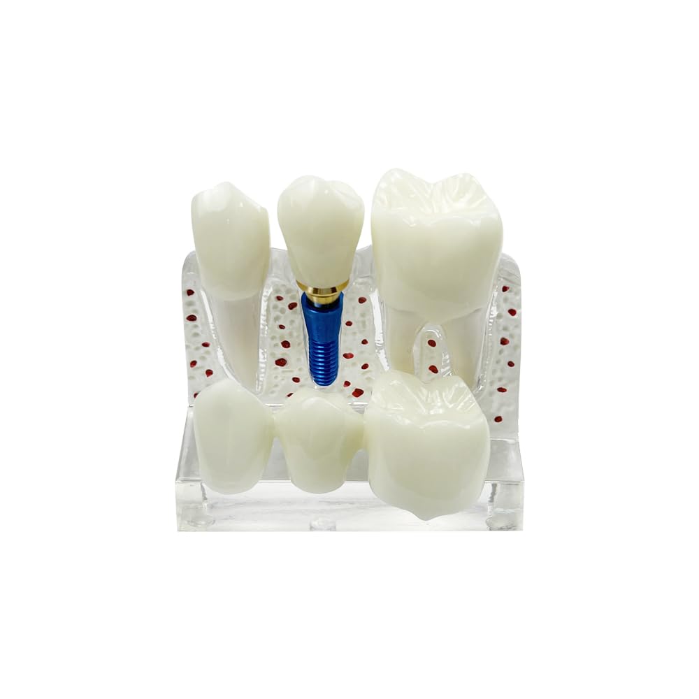 SENLIN DENTAL 4 Times Teeth Implant Models, Dental Model for Patient Education and Class Studying Teeth Model, Dental Implant, Crown and Bridge Model for Presentation (White)