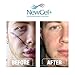 NewGel Plus Scar Gel by MyNewGel Advanced Professional Silicone Treatment for Old and New Scars w Vitamin E, High-Potency for Surgery, Keloids, Burns, and Facial Blemish Scars (30 Grams) - 1 oz