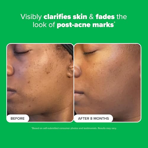 Thumbnail image for Paula's Choice BOOST 10% Azelaic Acid Booster