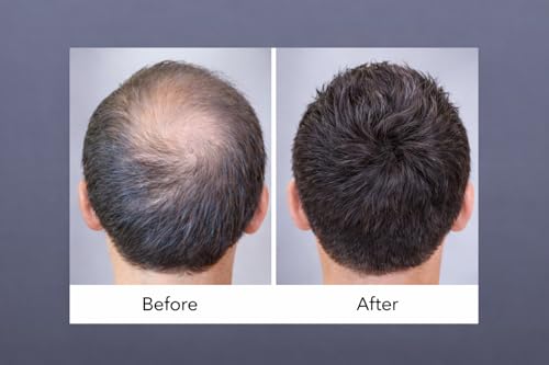 Image of Hair Building Powder for Men & Women - 27.5g | Instant Hair Thickening & Volumizing Solution | Covers Thinning Hair & Receding Hairlines