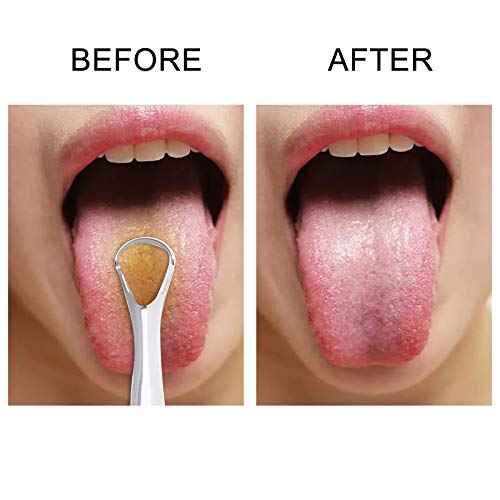 Queenser Raspador de língua de aço inoxidável de 2 unidades para limpeza de língua Limpadores de lín