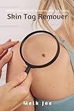 Skin Tag Remover: Natural Remedies for Removing Skin Tag Safely