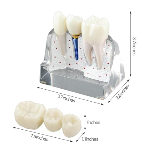 Hoite Zahnimplantatmodell, transparent, mit Harzkronen, Metallimplantaten, Abutments, trennbaren Teilen, 4 x Magnete, sichere Brücke