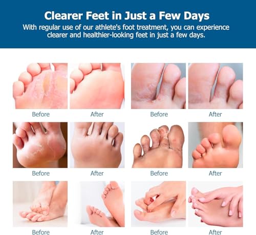 Image of RoyceDerm Extra Strength Athletes Foot Treatment Cream - Powerful Antifungal Relief for Itching and Burning - Suitable for Men and Women