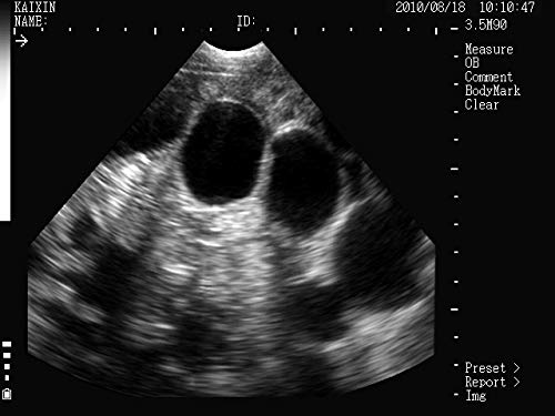 Ultrasound image showing ovarian follicles