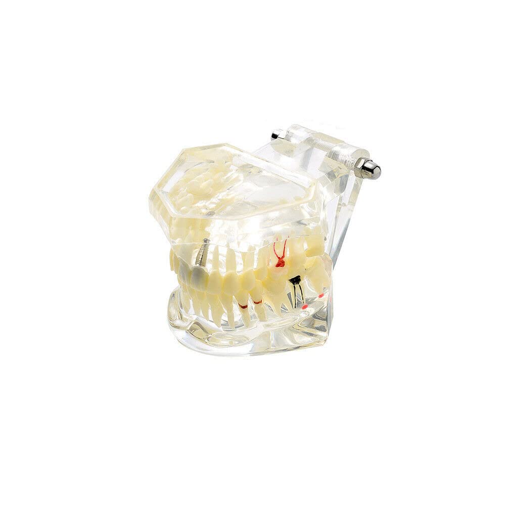 EasyinsmileDental Teeth Model for Implant Teaching Study Mouth Models with Removable Teeth