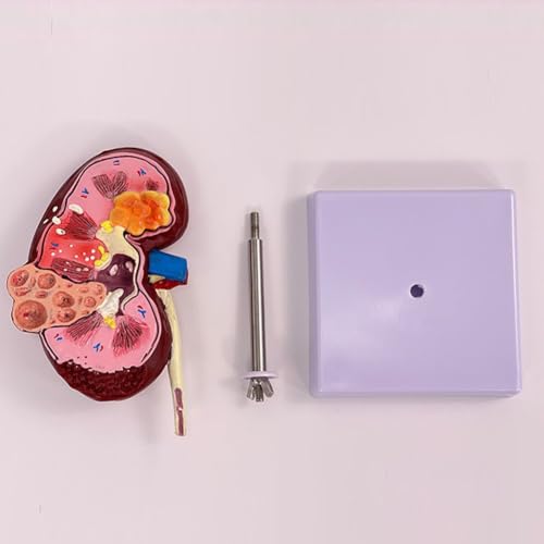 Modèle de pathologies rénales anatomique double face pour bureau médical - 5