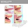 Teeth Repair Kit, Temporary Teeth Replacement Kit, Do it Yourself Thermal Fitting Beads, Moldable False Teeth for Snap On Instant and Confident Smile