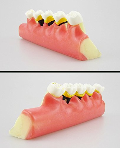 La maladie parodontale dentaire prématurée associe le modèle pédagogique des études sur les dents de dents Typodont