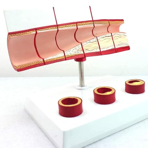 Modèle vasculaire de thrombose AMITD numéroté pour cours médicaux - 2