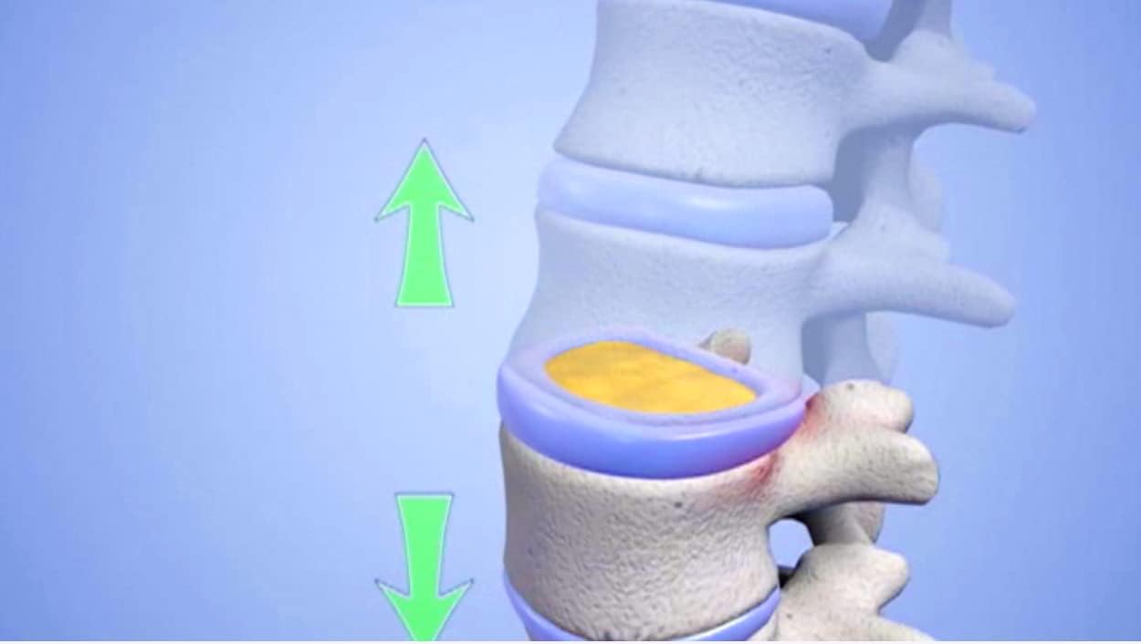 Neck-Ease Cervical Traction Device - Foot Powered - Safe & Effective Neck Pain Therapy at Home