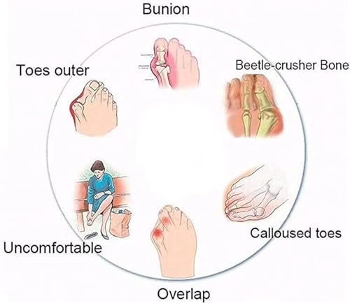 Men's Beach Sandals Summer Lightweight Ring Toe Bunion Flat Slippers, Casual Soft Non-Slip Foot Correction Men's Beach Sandals for Plantar Fasciitis2