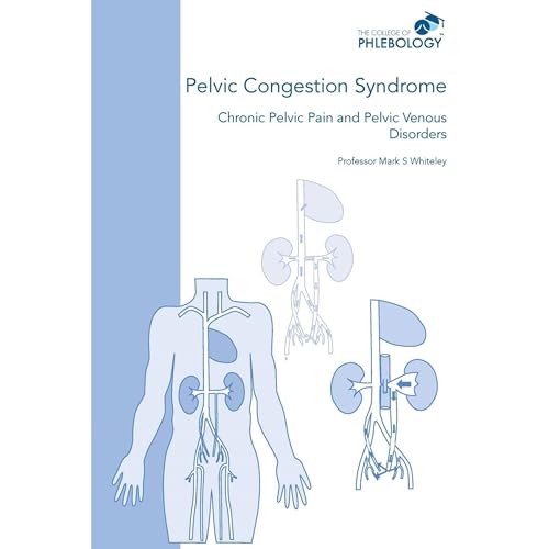 Pelvic Congestion Syndrome - Chronic Pelvic Pain and Pelvic Venous Disorders Audiolibro Por Mark S Whiteley arte de portada