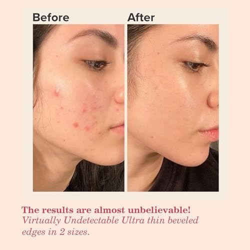 Image of WILDGLOW Korean Hydrocolloid Overnight Acne Pimple Patch | Heal Pimples, Absorbs Pus-Oil, Reduces Redness | Enriched with 2% Salicylic Acid, Tea Tree Oil & Glycolic Acid | All Skin Types | 36 Patches