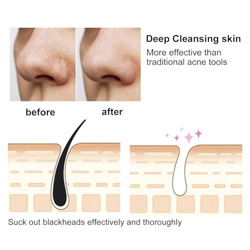 Gbzw HTY-ZHU Blackhead Removal Tool With Hot Compress, 3 Adjustment Modes & 4 Suction Heads Pore Vacuum,Facial Pore Cleanser  thumb #4
