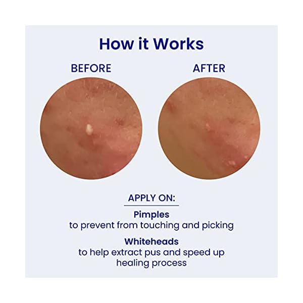 FaceTory-PM-Spot-Fighter-Blemish-Patches-OvernightNighttime-156-Hydrocolloid-Patches-12mm-and-14mm-2-Packs-of-78-Patches FACETORY PM Spot Fighter Blemish Patches - Overnight/Nighttime Pimple Patch, For Acne-Prone Skin - 156 Hydrocolloid Patches, 12mm and 14mm (2 Packs of 78 Patches)