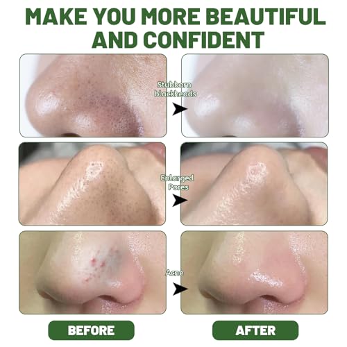 Mitesserentferner Stripes,100 Stück Mitesser Strips mit Natürliche Bambuskohle,Nose Strips Blackhead,Tiefenreinigende Mitesser zum Entfernen von Mitessern und zum Freimachen verstopfter Poren