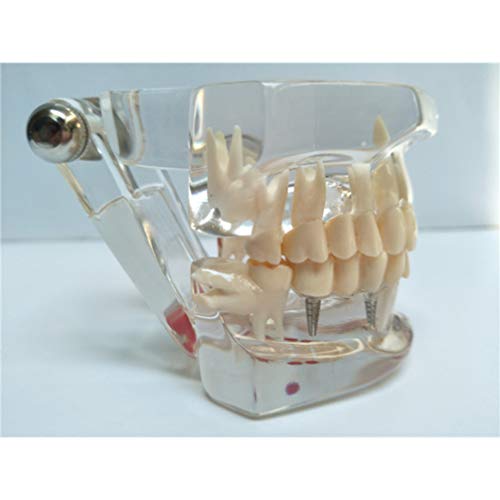 ULTECHNOVO Modelo de Simulação de Dentes Modelo Anatômico de Dentes Humanos Transparente Doença Dent
