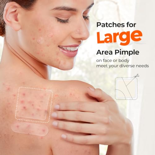 TKTK Hydrocolloid Bandages, 45 x 45 mm Large Pimple Patches for Face, XL Acne Patches for Body, Back, Forehead, Cheek Zit Breakouts, Big Hydrocolloid Patch (Square, Strip, Dot 5 Sizes 120 Count)