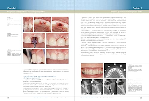 Rimodellamento Osseo Perimplantare. Background Scientifico E Implicazioni Cliniche - 6