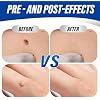 Extra Strength Wart Remover Liquid with 17% Salicylic Acid, Fast Acting Treatment for Plantar & Common Warts, Corn Remover for Feet and Toes (15ml, Warts Remover (1 P))