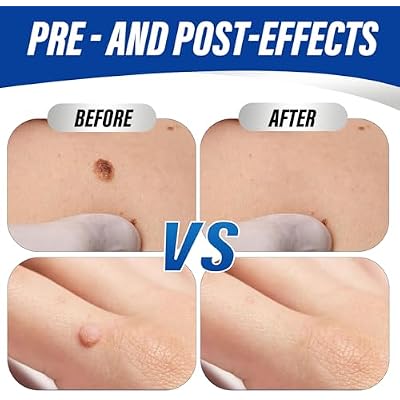 Extra Strength Wart Remover Liquid with 17% Salicylic Acid, Fast Acting Treatment for Plantar & Common Warts, Corn Remover for Feet and Toes (15ml, Warts Remover (1 P))